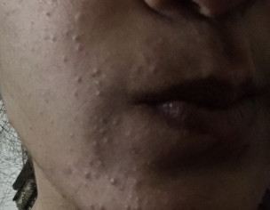 Acne Issue