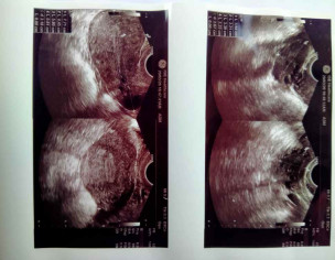 Bilateral Polycystic Ovaries 