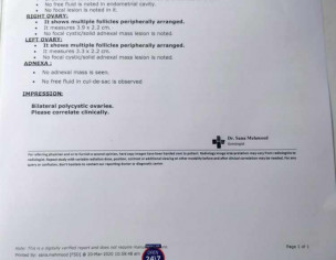 Bilateral Polycystic Ovaries 