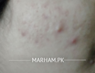 Acne Issue