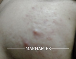 Acne Issue