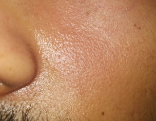 Skin Issue