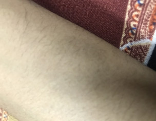 Fixed Drug Eruption Patches