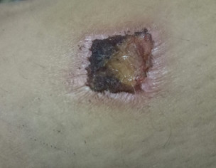 Wound Scab