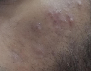 Pimples,acne,scar,hair Fall