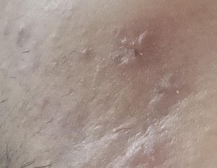 Pimples,acne,scar,hair Fall