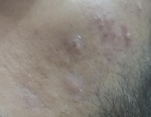 Pimples,acne,scar,hair Fall