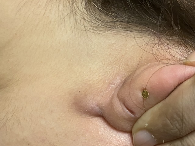 painful cyst behind ear