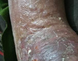 Dry Eczema On Leg
