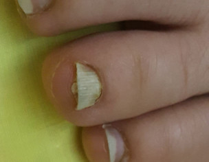 Foot Nail Is Coming Off