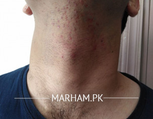 Skin Problem. After Shaving.