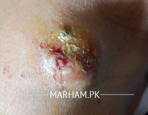 Dana On Shoulder (Dermatologist)