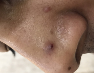 Pus Pimples On Face
