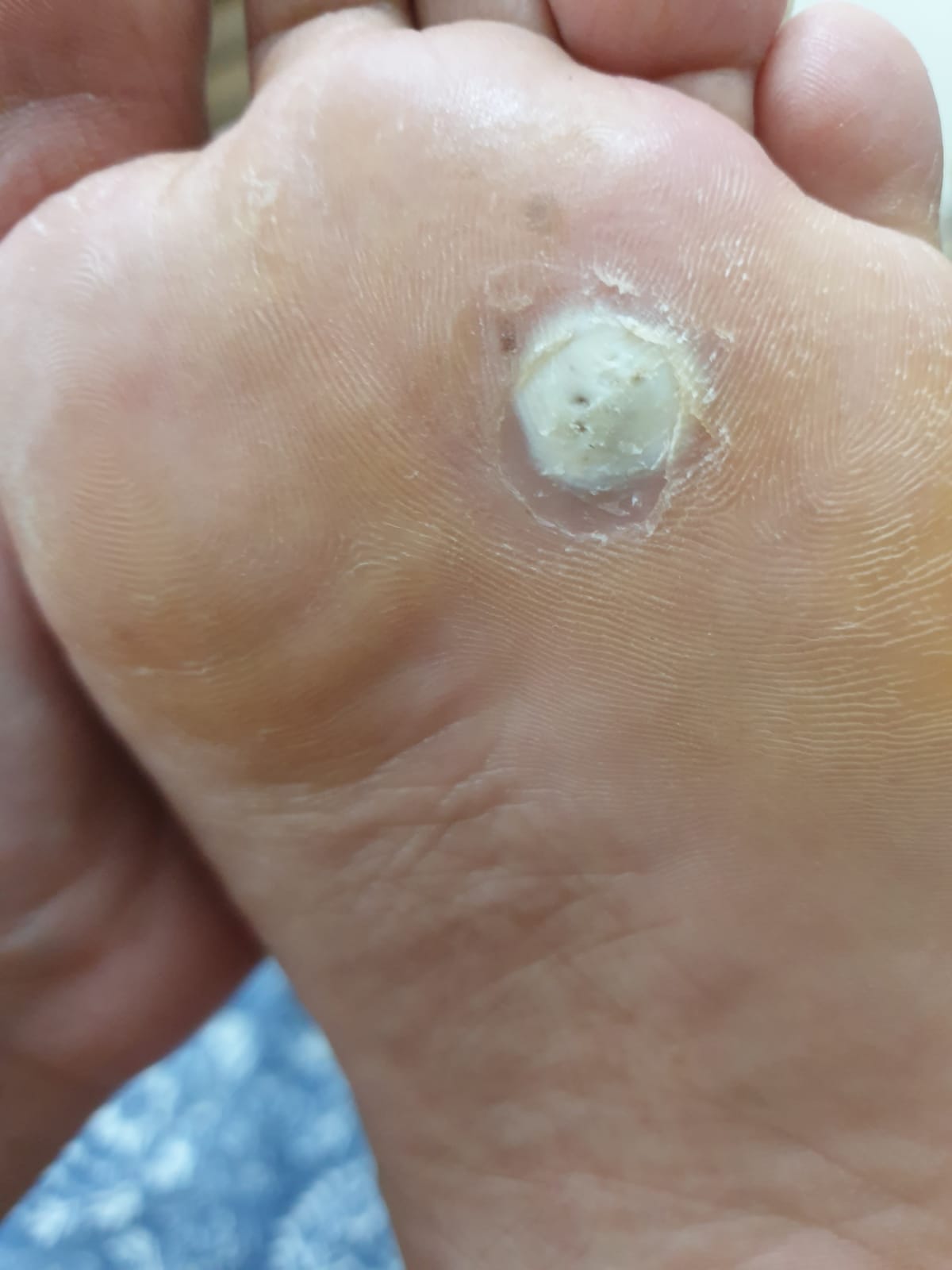 Ask a Dermatologist Online for Foot Wart/corn