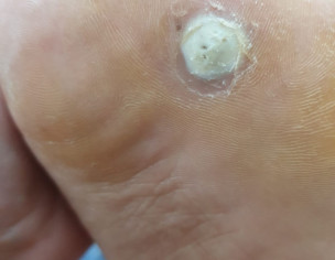 Foot Wart/corn