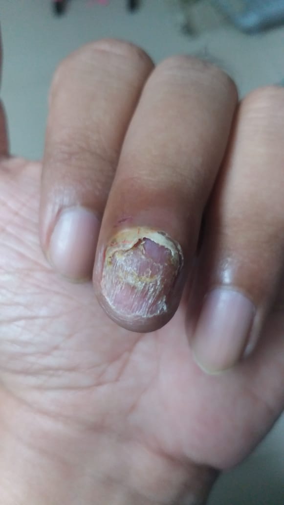 Ingrown toenails: digging out the facts - BPJ65 December 2014