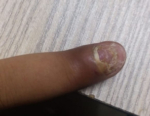 Fungus And Puss Under Nail
