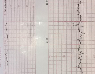 Labour, Complication