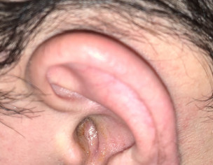 Pimple/white Head In Ear