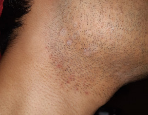 Skin(Face And Beard Moustace Area