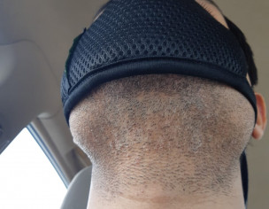 Skin(Face And Beard Moustace Area