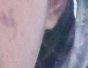 Skin Acne Black Spots