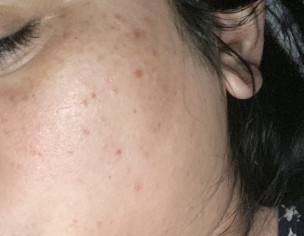 Skin - Acne -pigmentation .