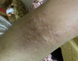 Itching With Bumps On Skin