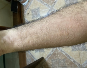 Itching With Bumps On Skin