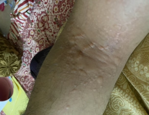 Itching With Bumps On Skin