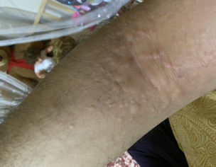 Itching With Bumps On Skin