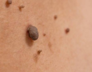 Mole Inner Thigh &amp; Neck