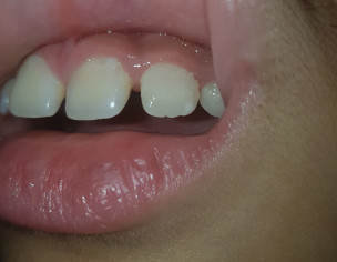 Gums Above Teeth Getting Brown