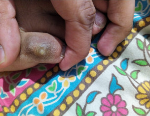 A Hard Stone Like Pimple