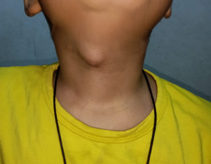Neck Mass 
