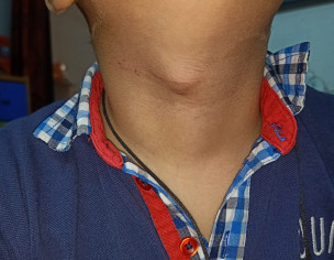 Neck Mass 
