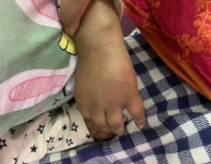 Mosquito Bite Allergy