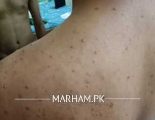 Skin Issue Red Acne