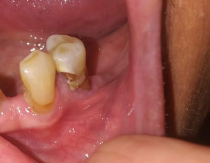 Dental Infection