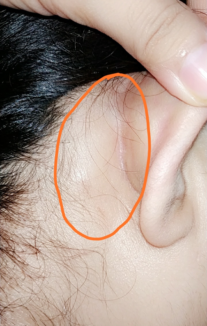 ball behind ear