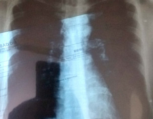 Cough And Breathing Problem 