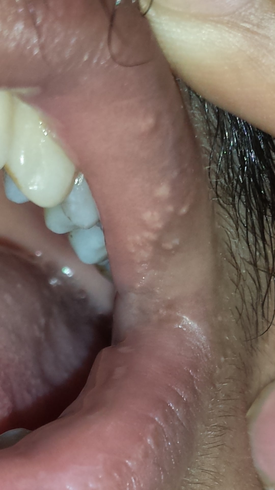 white spots inside lips