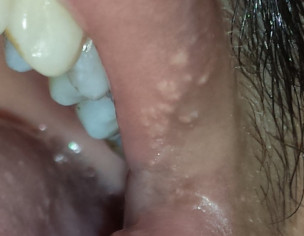 white spots on gums