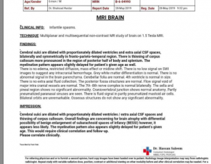 Brain Etrophy Infantile Spasms 