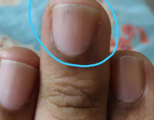 Possible Splinter Hemorrhage On Nails
