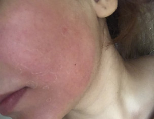 Skin Redness