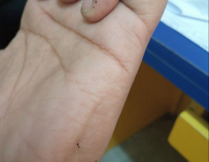 Small Black Dots On Palm