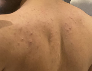 Pimples On Back