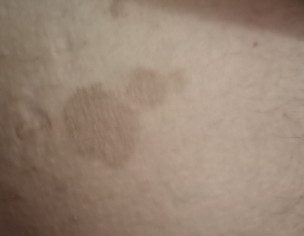 Patches On Skin