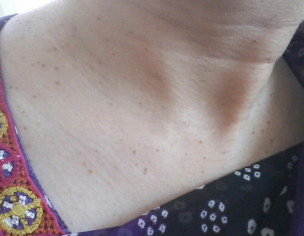 Seborrheic Dermititis 